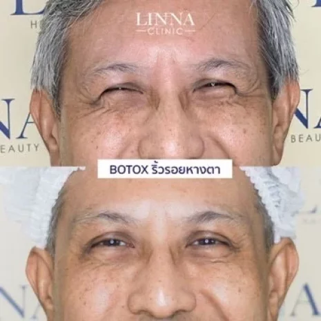 Review Botox Wrinkles