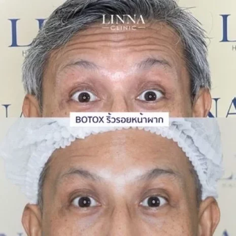 Review Botox Wrinkles