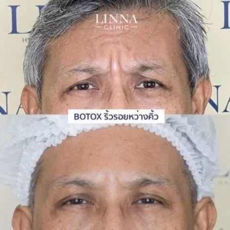 Review Botox Wrinkles