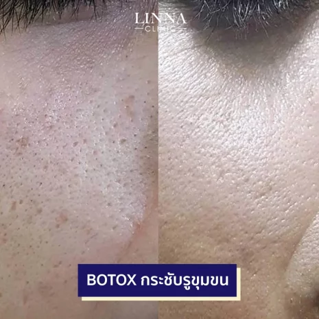 linna-review-botox-2.webp