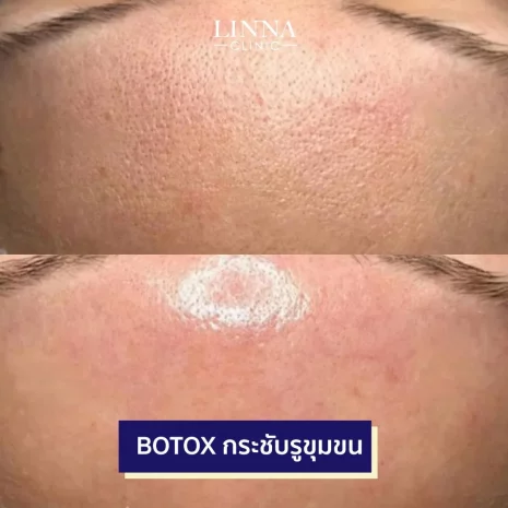linna-review-botox.webp