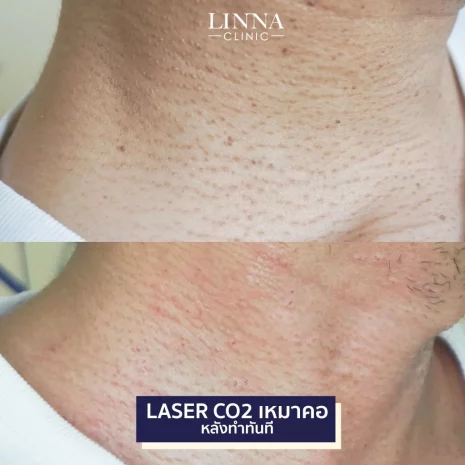 รีวิว Co2 Laser