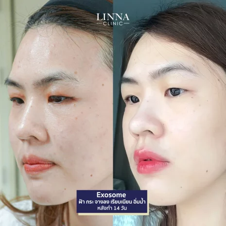 linna-รีวิวเซเลปเจ้าของธุรกิจ-7-exosome-คุณบลู.webp