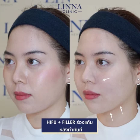 Review Hifu + Filler