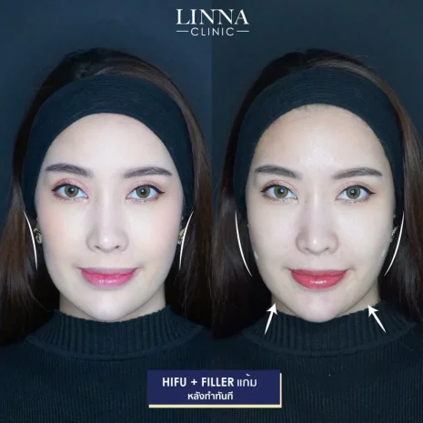 Review Hifu + Filler